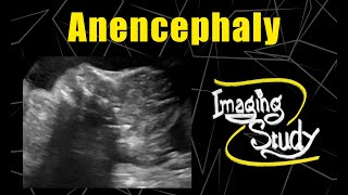 Fetal Anencephaly  Neural Tube Defect  Ultrasound  Case 109 [upl. by Leile]