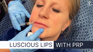 PRP for Natural Lip Injections [upl. by Aleafar]