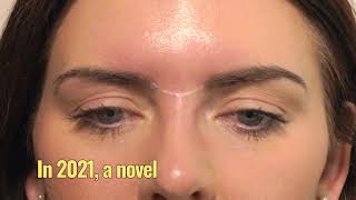 HowTo Treat The Glabella With Botox  3 Point Injecting Technique  Dr Chris Hutton [upl. by Vivien]