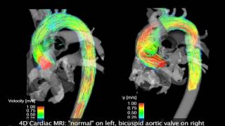 4D MRI flow [upl. by Hirz]