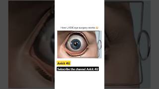 How Lasik Surgery works  Eye Surgery ytshorts shortvideo eye eyesurgery [upl. by Aidas947]