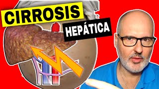 CIRROSIS HEPÁTICA 💥 Causas Síntomas y Tratamiento [upl. by Navert656]