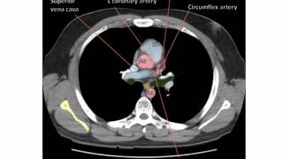 Anatomy of a Transverse CT of the Thorax [upl. by Flodur]