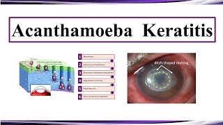 Acanthamoeba Keratitis [upl. by Ainoyek]