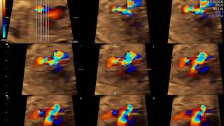 Fetal Echocardiography Registry Review [upl. by Arela224]