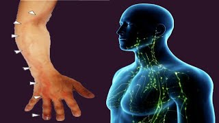 Lymphangitis Causes And Symptoms [upl. by Nagaet15]