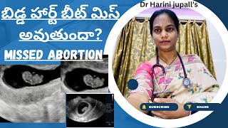 EARLY PREGNANCY LOSSMISSED ABORTION [upl. by Mor]