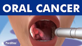 Oral Cancer Signs Symptoms Treatment  Max Hospital [upl. by Backer]