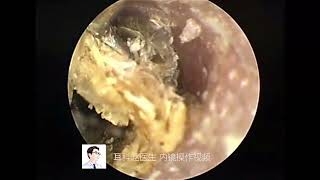 Hard external auditory canal cholesteatoma and small earwax [upl. by Newcomb]