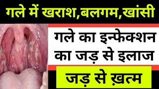 Sore Throat Infection In HindiThroat Infectionगले में खराश होनागले में दर्दकारण लक्षण एवं उपाय [upl. by Ellehcram]