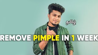 HOW TO REMOVE PIMPLE PERMANENTLY  IN TAMIL  SARAN LIFESTYLE [upl. by Yemrots]