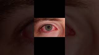 Conjunctivitis  Common eye conditions during cold months [upl. by Rehpotsihrc]