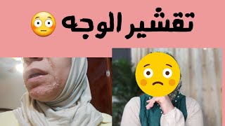 تقشير بارد للوجه قبل وبعدالتقشير البارد للوجه [upl. by Kciredohr748]