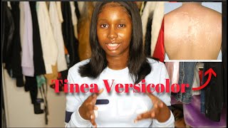 ITS NOT ECZEMA Treating my Tinea Versicolor  Black Skin Friendly [upl. by Diannne555]