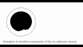 Vermiform movement of the iris spincter muscle  Adies Pupil [upl. by Shewmaker]