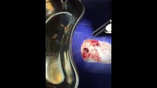 Myiasis  Removal of fly larvae from wound in a husky dog [upl. by Nivonod904]