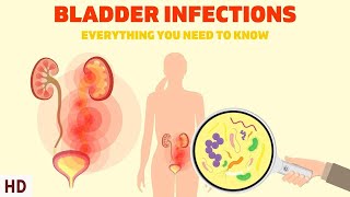 Bladder Infections The Silent Epidemic Affecting Millions of Women [upl. by Aeht]