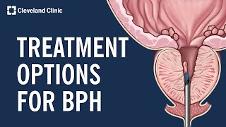 Treating Benign Prostatic Hyperplasia BPH [upl. by Attegroeg]