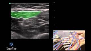 How To Ultrasound Guided Saphenous Nerve Block 3D Video [upl. by Nort]