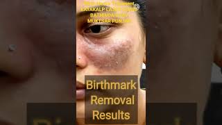 Birthmark Treatment Results I Birthmark I birthmarkremoval [upl. by Tsirc]