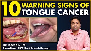 10 Warning Signs of Tongue Cancer  Signs Of Oral Cancer  Dr Karthik  TX Hospitals [upl. by Adal]