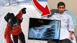 I BROKE MY COLLAR BONE  LIVE FOOTAGE [upl. by Loni401]