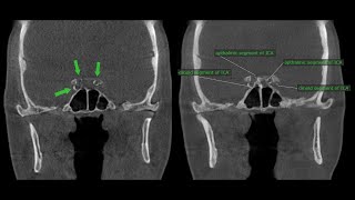 Detecting signs of Type II Diabetes Mellitus on CBCT Xray Images [upl. by Verity970]