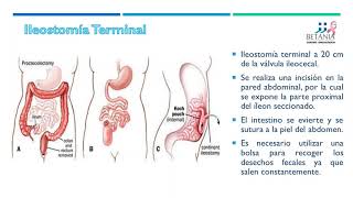 Ileostomía [upl. by Schoenberg]