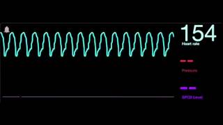 25 Taquicardia ventricular [upl. by Odlaniger]