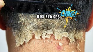 Psoriasis Scalp Scratching Big Flakes 610 [upl. by Orren]