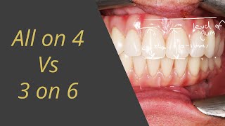 Allon4 vs 3on6 Whats Better For a Full Set of Teeth on Dental Implants [upl. by Steere412]