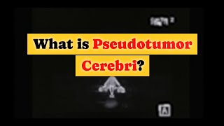 What is Pseudotumor Cerebri [upl. by Anitirhc196]