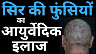 Ayurvedic Treatment for Scalp Folliculitis Causes amp Home Remedies [upl. by Roti]