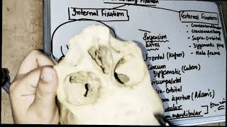 internal fixation mandible fracture  part 1 [upl. by Leclair]