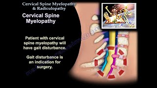 Cervical Spine Myelopathy amp Radiculopathy  Everything You Need To Know  Dr Nabil Ebraheim [upl. by Ranit]