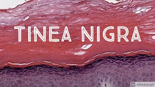 Tinea Nigra Black Mold Skin Infection Dematiaceous Pigmented Fungus 5Minute Pathology Pearls [upl. by Shaver]