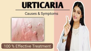 Urticaria treatment  Hives causes symptoms prevention and treatment [upl. by Arad]