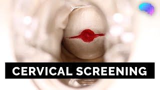 Cervical Screening SMEAR  OSCE Guide  UKMLA  CPSA [upl. by Pomfrey869]