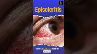 What is Episcleritis  Ophthalmology  eye ophthalmology episcleritis eye peramedical [upl. by Oiziruam193]