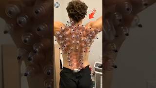 Cupping therapy explained 🫥 [upl. by Nowed595]