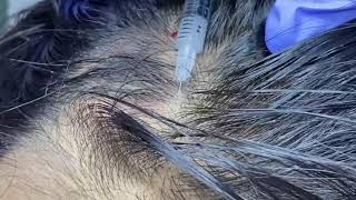 Intralesional Injection Treatment for Alopecia Areata [upl. by Meesak93]