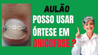 Aulão Posso Usar Órtese em Caso de Onicofose [upl. by Htieh]