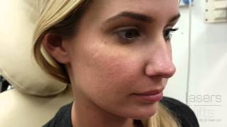 Removing acne scars in 5 minutes [upl. by Inoj]