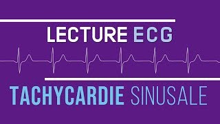 Interprétation ECG  Tachycardie Sinusale [upl. by Cirred]