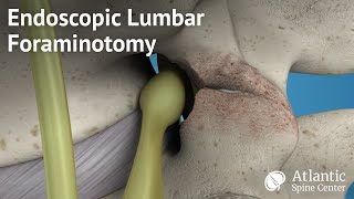 Endoscopic Lumbar Foraminotomy [upl. by Campos]