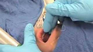 IntubationHow to perform endotracheal intubation  2 [upl. by Aratak]