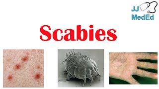 Scabies Skin Condition  What Is It Classic vs Crusted Types Signs amp Symptoms Treatment [upl. by Nolrak]