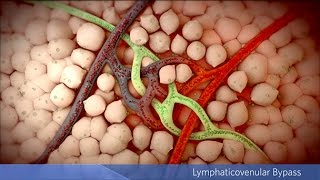 Lymphedema Surgery Lymphaticovenular Bypass [upl. by Hesler]