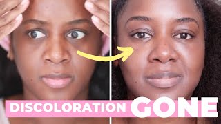 How I Got Rid of My Dark Circles Black Skin [upl. by Rodmun]