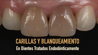 Carillas y blanqueamiento en dientes tratados endodónticamente [upl. by Cristabel]